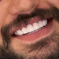 کامپوزیت دندان