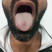 حجامت و رگ گیری درمان بیماریها