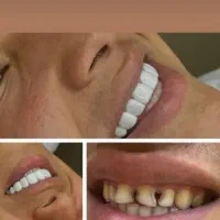 جشنواره کامپوزیت زیبایی دندان و ترمیم دندان