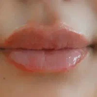 تزریق ژل و بوتاکس