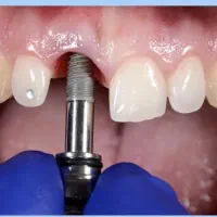 ایمپلنت با تخفیفات ویژه زمستانه