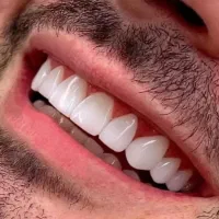 کامپوزیت دندان