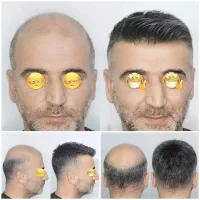 پروتز مو طبیعی DEMO HAIR