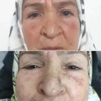 جشنواره پاک کردن تتو و حذف لک ،کربن تراپی تضمینی