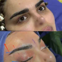 جراحی لیفت دائم شقیقه پیشانی آندوسکوپیک/جراحی بینی