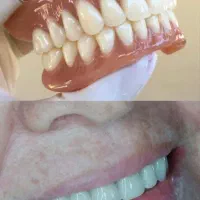 دندان مصنوعی تحویل ۵ ساعته 7/900 فاکتور بیمه