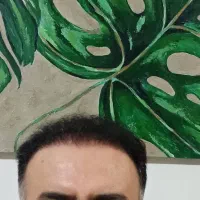 کاشت مو پرتراکم با تضمین کتبی نقد اقساط|خدمات آرایشگری و زیبایی|ساری, |دیوار