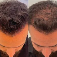 قبل ازاینکه مجبور بشی کاشت مو کنی ببین