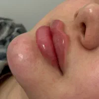فیلر و بوتاکس