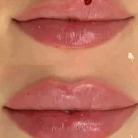 نیاز ب مدل جهت فیلر و بوتاکس و مزوژل