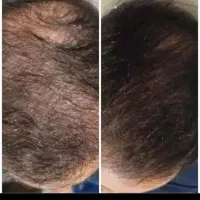 انجام مزو وپی ارپی واگزوزوم تراپی باتخفیف ویژه عید