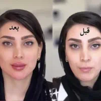 فیلر لب از ۵۰۰ بوتاکس از ۴۵۰  ظرفیت محدود