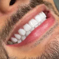 دندانپزشکی زیبایی درمانی کشیدن