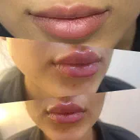 تخفیف ویژه فقط دوشنبه ها  مزو‌ژل ها فیلر و بوتاکس