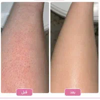 لیزر مو vip تضمینی ، ۵۰٪تخفیف