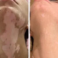درمان پسوریازیس پیسی اگزما
