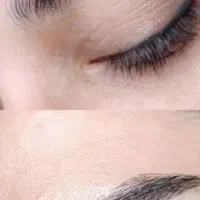 تاتوی ابرو و برداشتن خال و ...