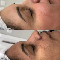 چربی ژل بوتاکس