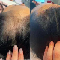 دیگه موهاتو کاشت نکن