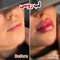 تخفیفات ژل و بوتاکس و نخ توسط شخص دکترچابکی