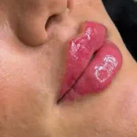 ژل وبوتاکس ومزوجوانساز