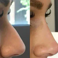 کوچیک شدن بینی تو ۲۰روز