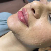 آموزش ژل و بوتاکس