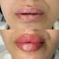 تزریق ژل و بوتاکس توسط پزشک متخصص