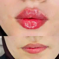 ژل لب وبوتاکس