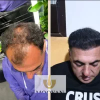 کاشت مو ۲۲ و کاشت ابرو ۱۵