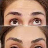 آموزش تزریق بوتاکس صورت و ژل لب و فیلر صورت