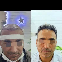 کاشت مو با شرایط استثنایی