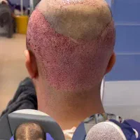 کاشت مو بوتاکس فیلر جهرم