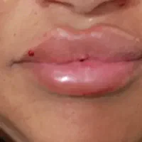 خدمات ژل بوتاکس