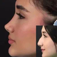 رینو پلاستی و ابدو مینو پلاستی