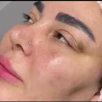 ژل بوتاکس