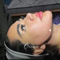 جشنواره ساکشن غبغب/بوکال فت/زاویه سازی دائم