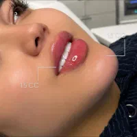 تزریق ژل و بوتاکس با بهترین برند900تا 1500