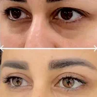 % بوتاکس فیلر بلفاروپلاستی لیفت کاشت ابرو مو %