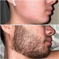 راهکار قطعی برای درمان کم‌پشتی ریش آقایان
