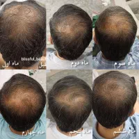 رفع مشکلات مو و پوست سر  مشاوره رایگان