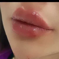 مدل ژل و بوتاکس جهت تکمیل آلبوم کاری
