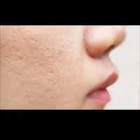 برطرف کننده گودی جای جوش