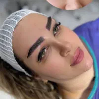 کاشت ابرو قسطی
