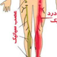 درمان‌۱۰۰درصدسیاتیک باروش TAHGSیاتاج سر
