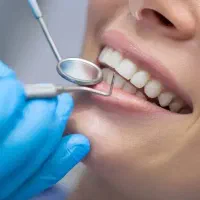 آفر ویژه بلیچینگ دندان(سفید کردن طبیعی)