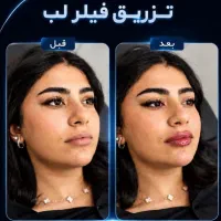 تزریق ژل وبوتاکس....
