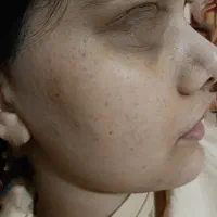 مزونیدلینگ /مزوتراپی مو فقط هزینه مواد محدود