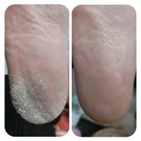 تخفیف تابستانه پدیکور پا