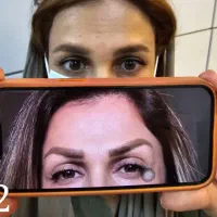 پاک کردن تتو ابرو/تتو بدن/خالکوبی/ خط چشم